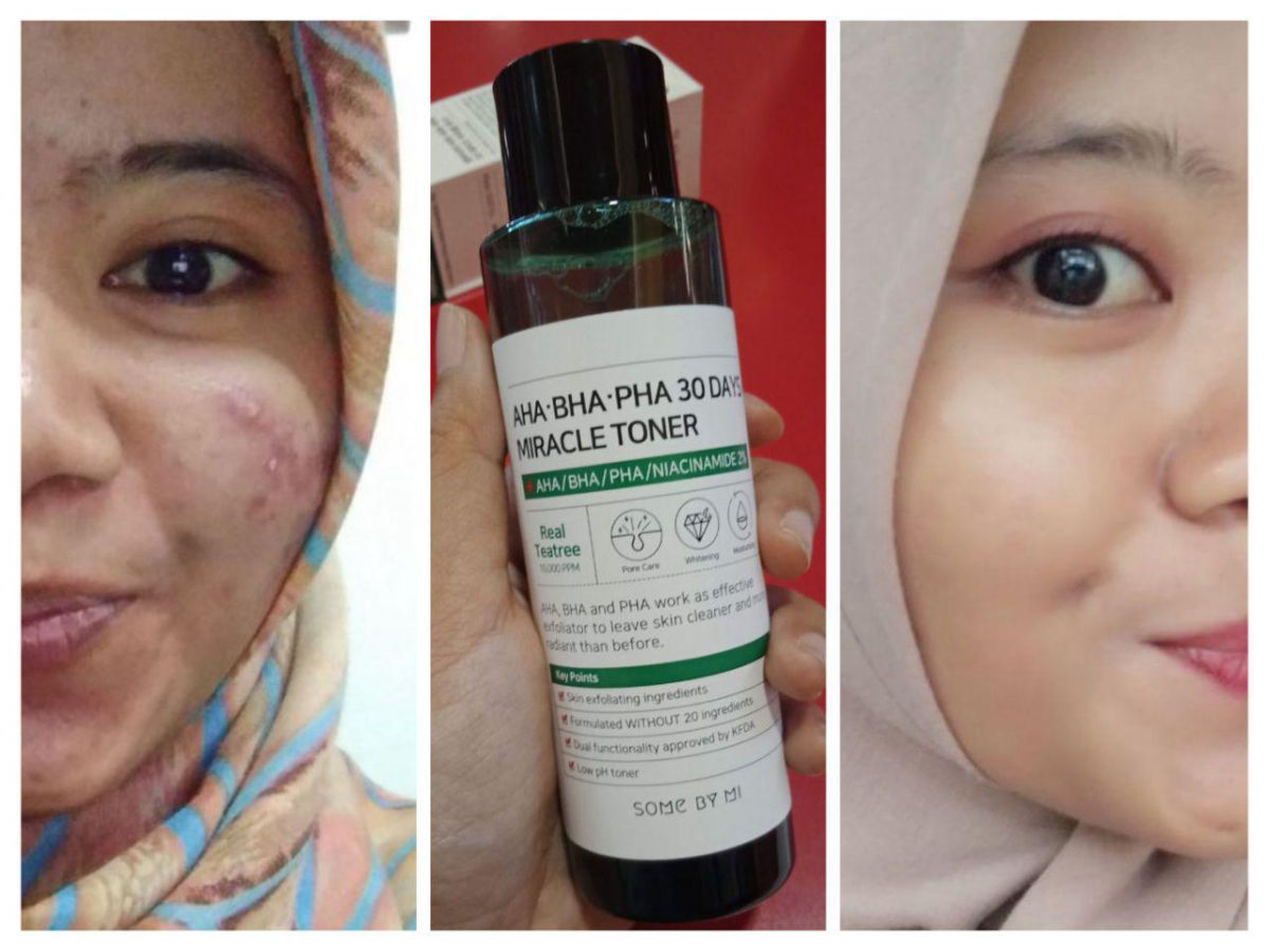 Kisah Sukses Lissa Memerangi Jerawat